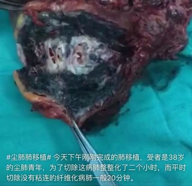 由于常年大量吸入灰尘,他们的肺会变得像石块一样坚硬,成为黑色的纤维